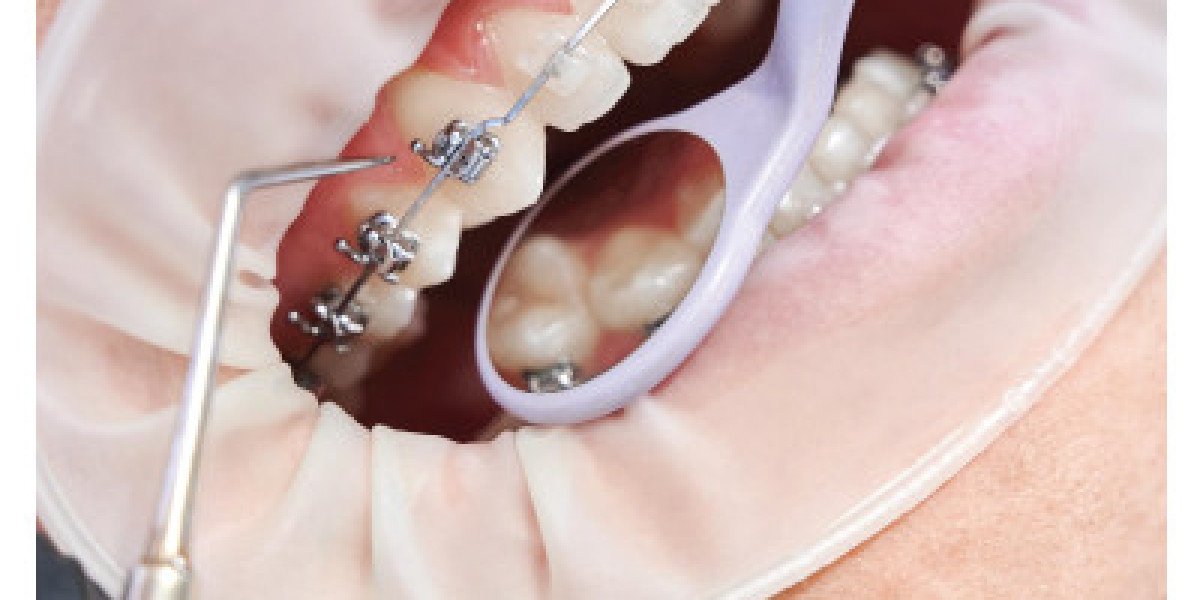 Dental Braces in Islamabad: The Ultimate Guide to a Confident Smile at Enfield Royal Clinic