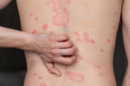 Find the Best Homeopathic Doctor for Psoriasis Treatment