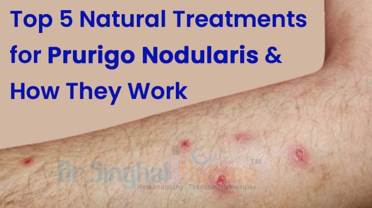 5 Natural Prurigo Nodularis Treatments and Their Effectiveness