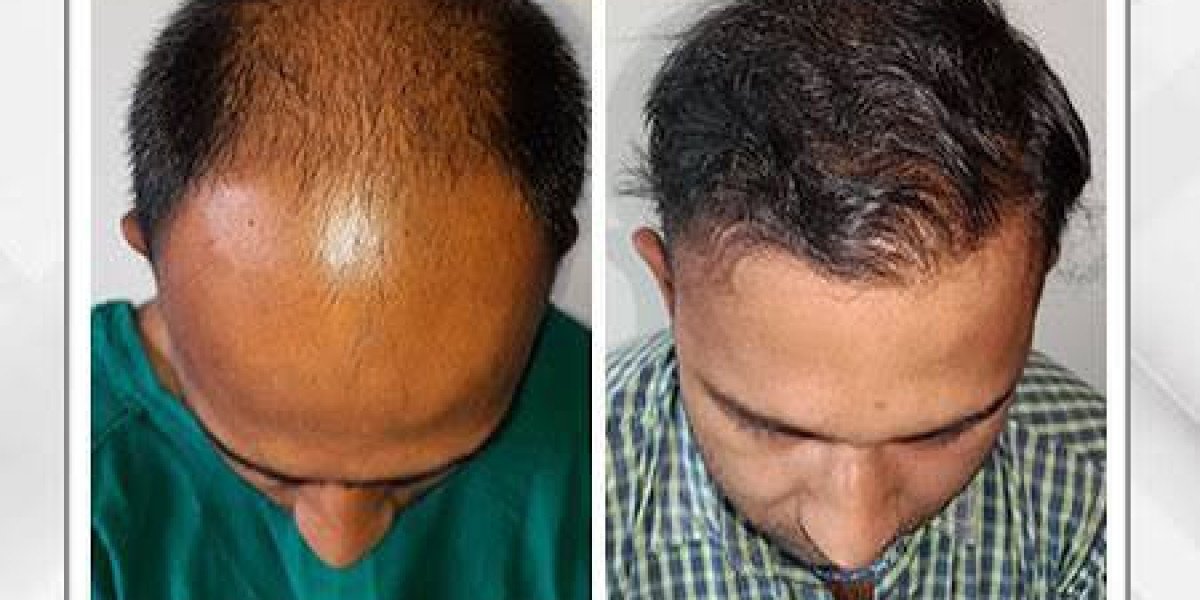 GFC Hair Treatment Cost | Best Hair Transplant in Guwahati – Dr. Pauls Online