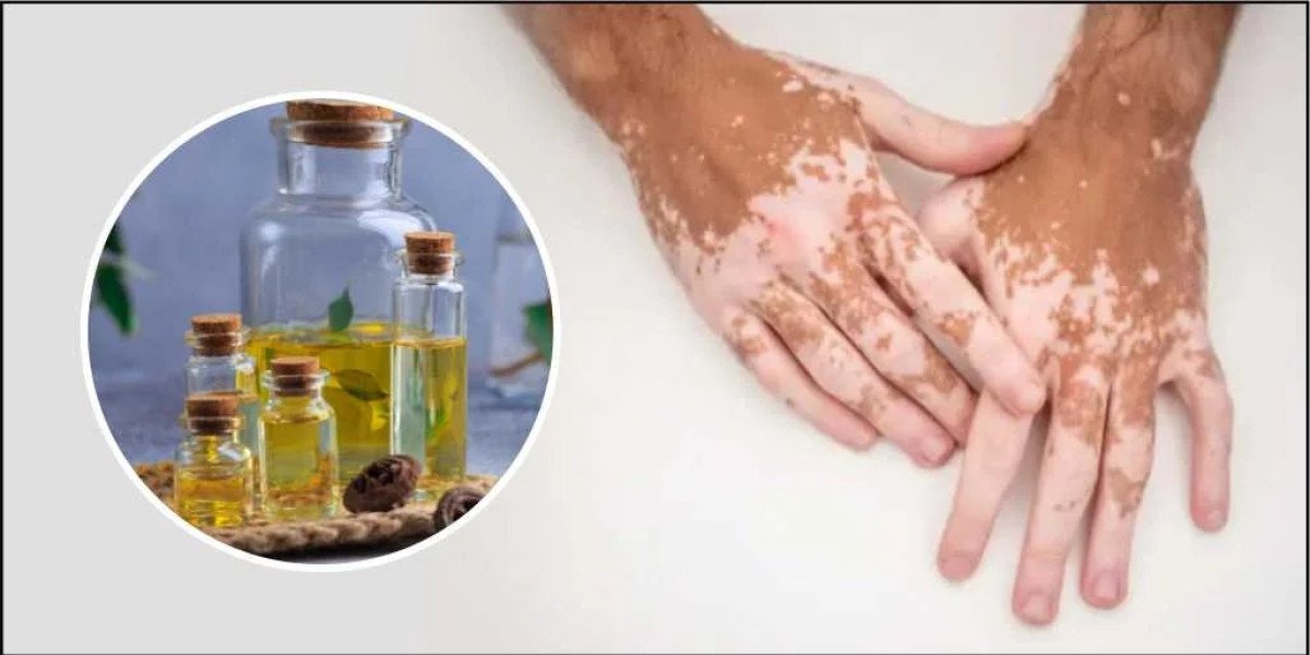 Vitiligo Treatment in Delhi – Kaya Kalp Global Delhi Contact