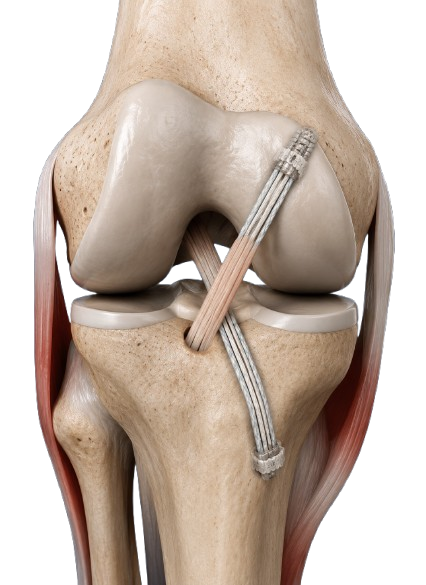 ACL Injury - Dr Dhruv Sharma