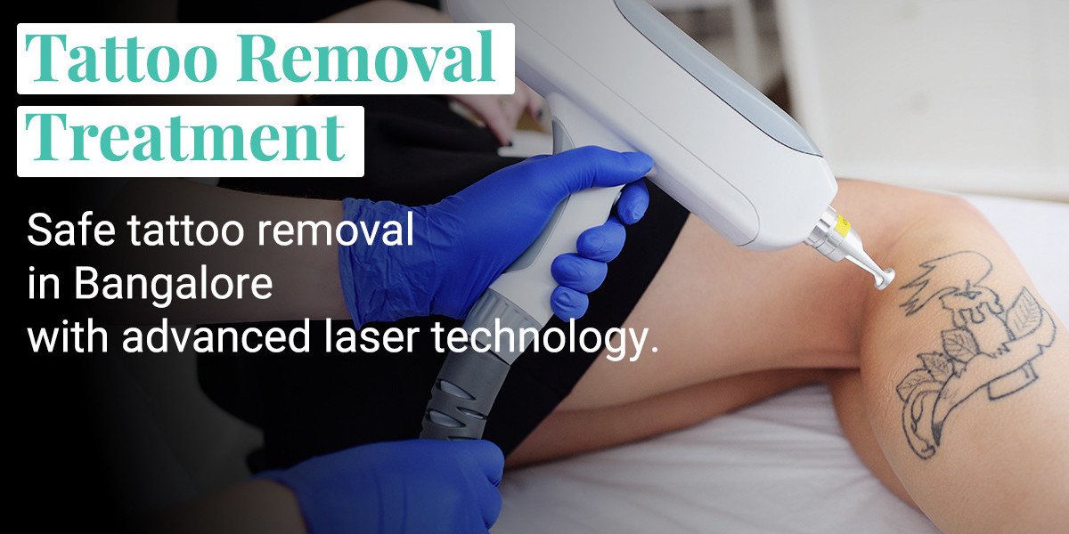 Does Laser Tattoo Removal Hurt? What Actually Happens During a Session?