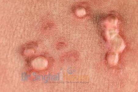 Best Homeopathic Treatment for HPV in India | Dr. Singhal Homeo